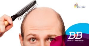 Alopecia androgénica.