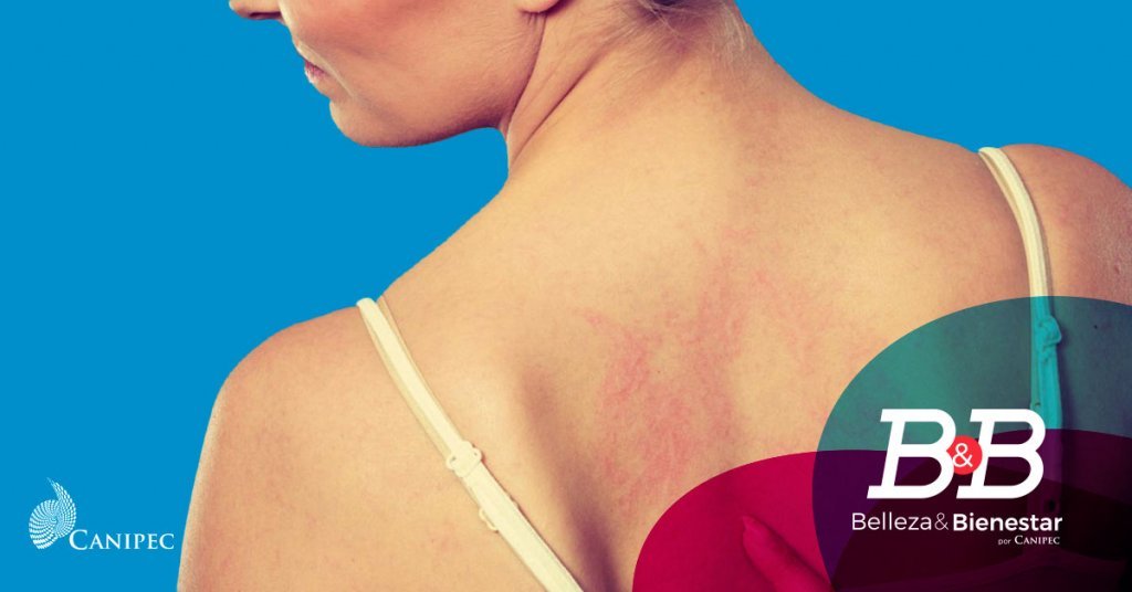 Dermatitis Atópica: Cuidado y Prevención