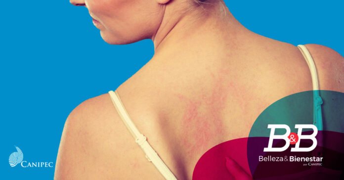 Dermatitis Atópica: Cuidado y Prevención