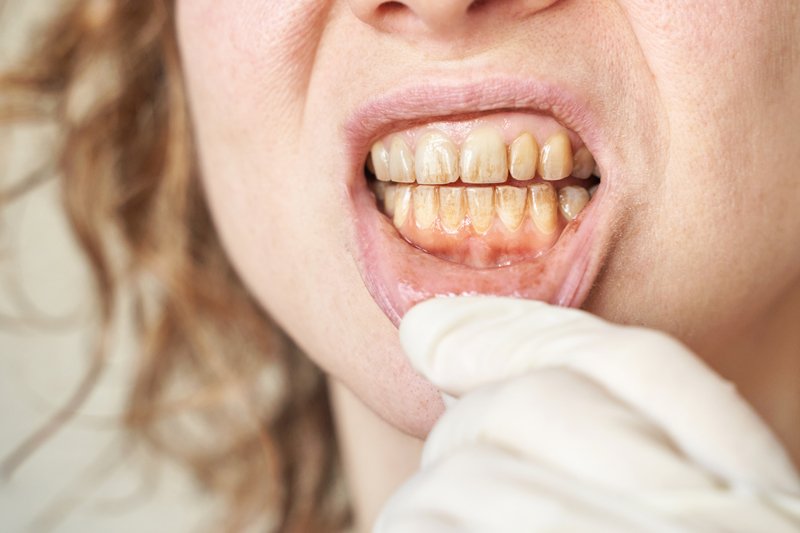 Dientes amarillentos por tabaquismo