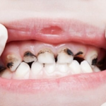 dientes-con-caries_2