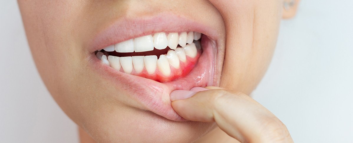 encías inflamadas en la lactancia