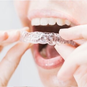 Férula nocturna para evitar el bruxismo