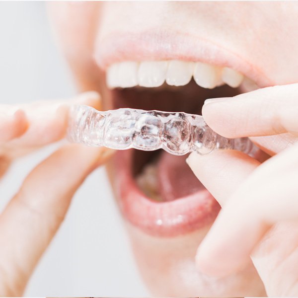 Férula nocturna para evitar el bruxismo