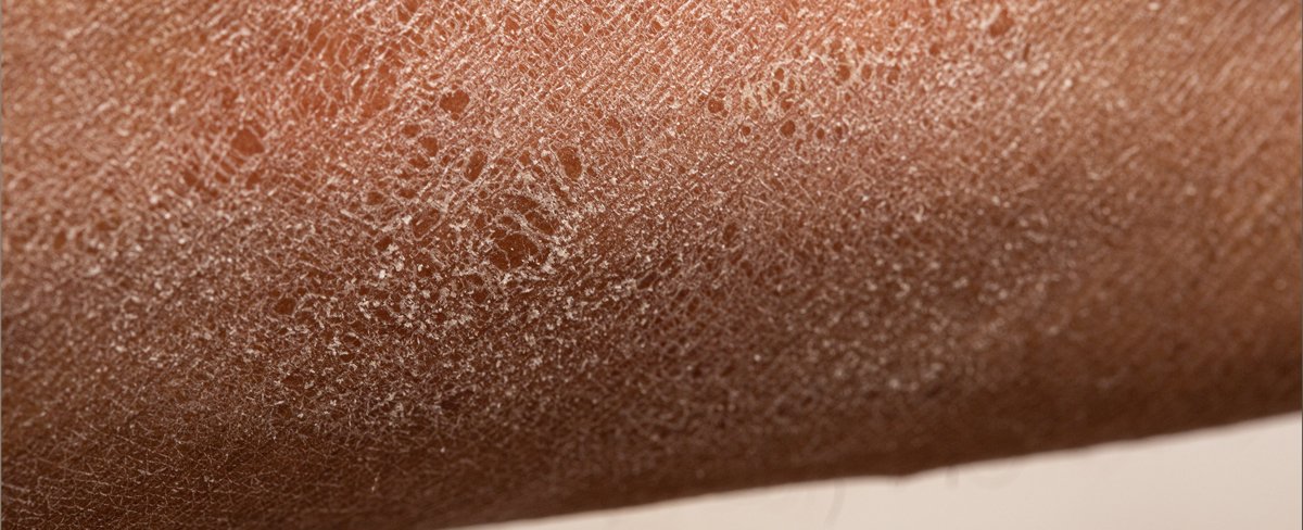 Piel reseca en invierno