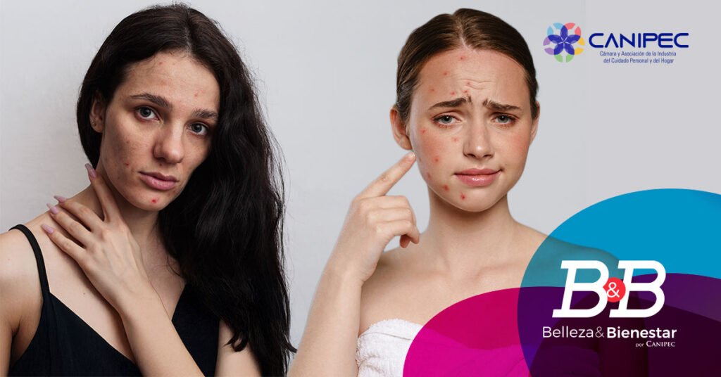 Piel con tendencia al acné: causas, cuidados y soluciones